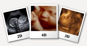 تفاوت انواع سونوگرافی بارداری