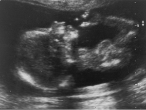 بررسی تحرک جنین در تست بیوفیزیکال