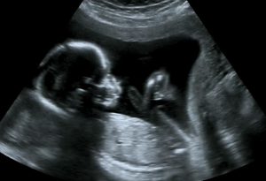 سونوگرافی 3 ماهه بارداری نقش مهمی دارند.