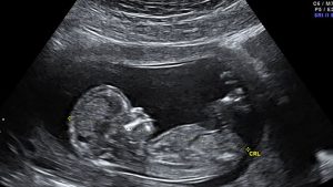 سونوگرافی 3 ماه اول بارداری