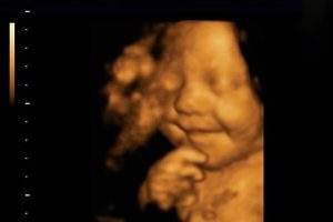انجام سونوگرافی سه بعدی و چهاربعدی در 3 ماه سوم بارداری