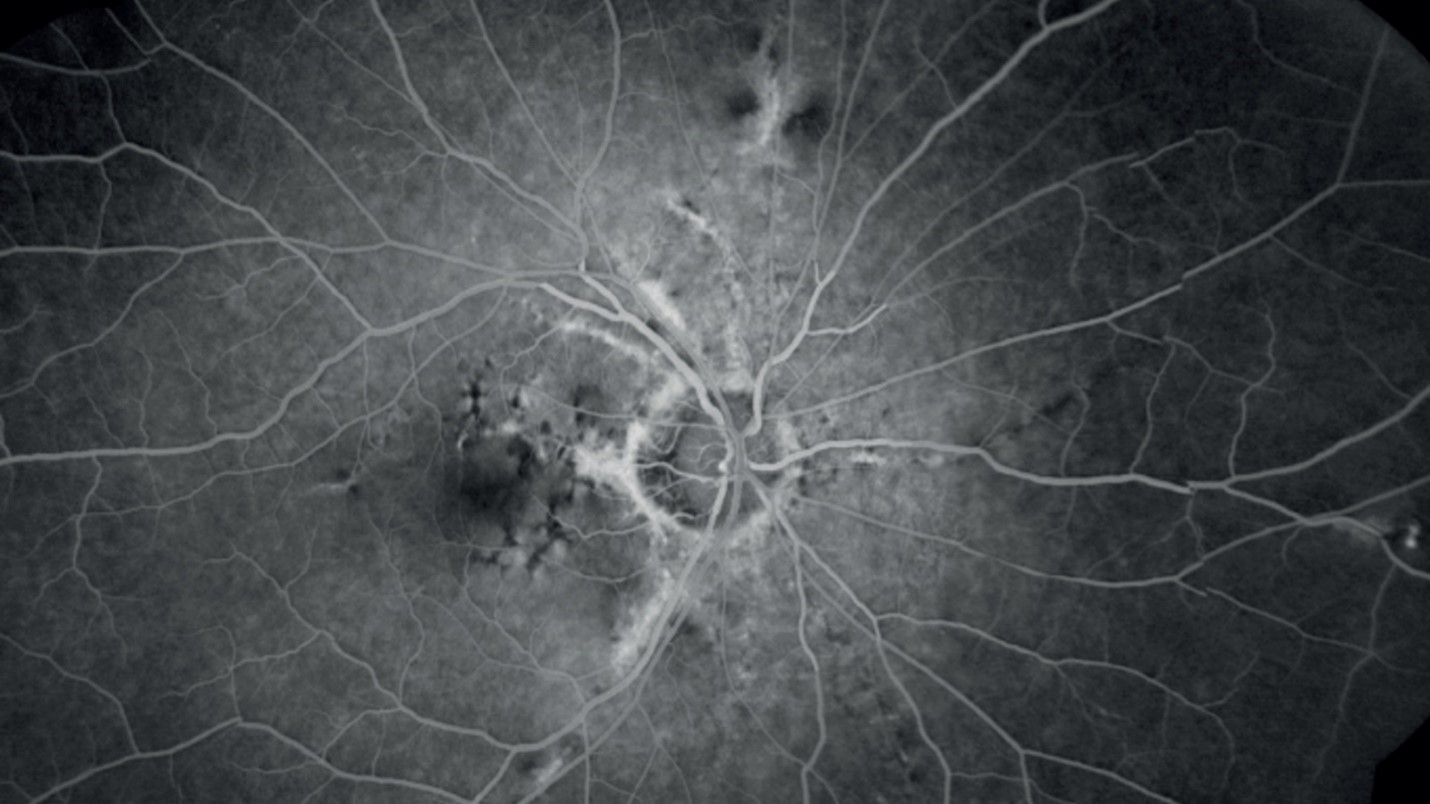 تصویر رگ‌های چشم به دست آمده از آنژیوگرافی چشم