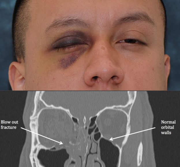 بررسی آسیب چشمی در سی تی اسکن چشم